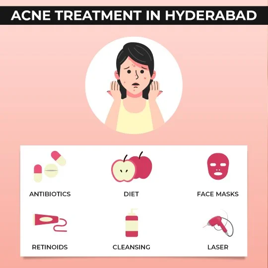 Acne Treatment in Hyderabad -  Treatments options available: Antibiotics therapy, Carbon laser peel and Laser treatment.